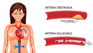 Cómo limpiar las arterias obstruidas naturalmente con sólo tres ingredientes