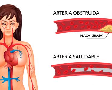 Cómo limpiar las arterias obstruidas naturalmente con sólo tres ingredientes