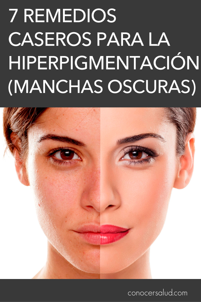 7 Remedios caseros para la hiperpigmentación (manchas oscuras)