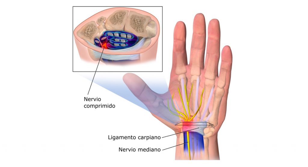 9 remedios naturales para tratar el síndrome del túnel carpiano