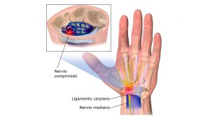 9 remedios naturales para tratar el síndrome del túnel carpiano