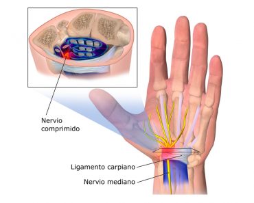 9 remedios naturales para tratar el síndrome del túnel carpiano