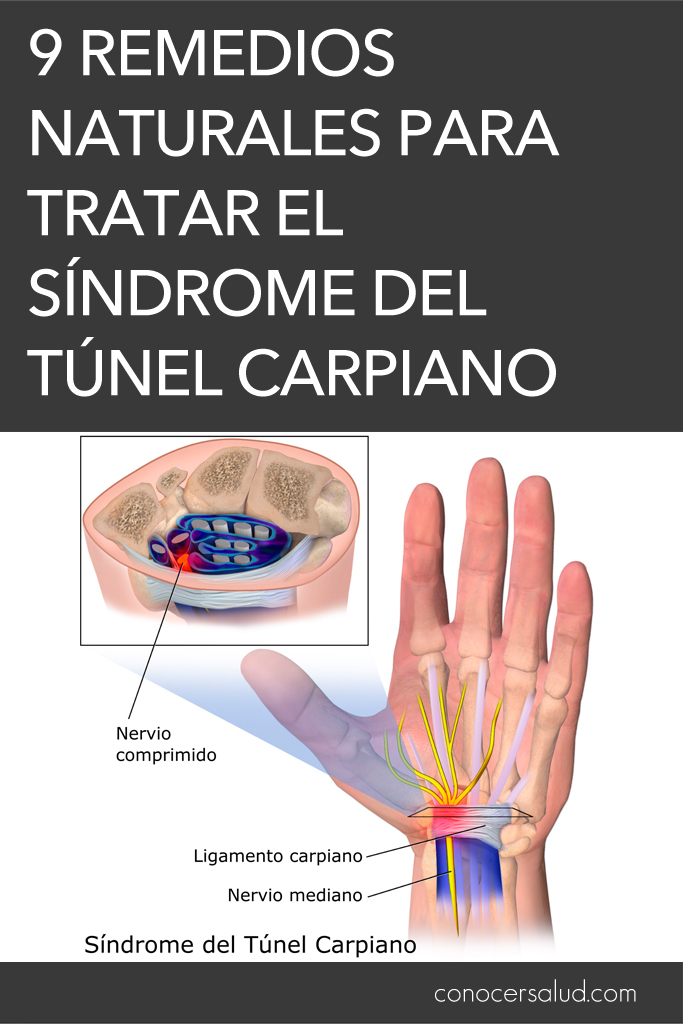 9 remedios naturales para tratar el síndrome del túnel carpiano