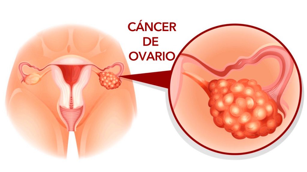 5 Señales de alerta temprana de cáncer de ovario que nunca deben ignorarse