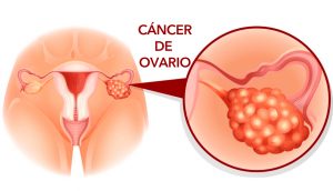 5 Señales de alerta temprana de cáncer de ovario que nunca deben ignorarse