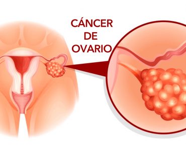 5 Señales de alerta temprana de cáncer de ovario que nunca deben ignorarse