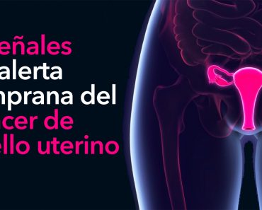 8 Señales de alerta temprana del cáncer de cuello uterino