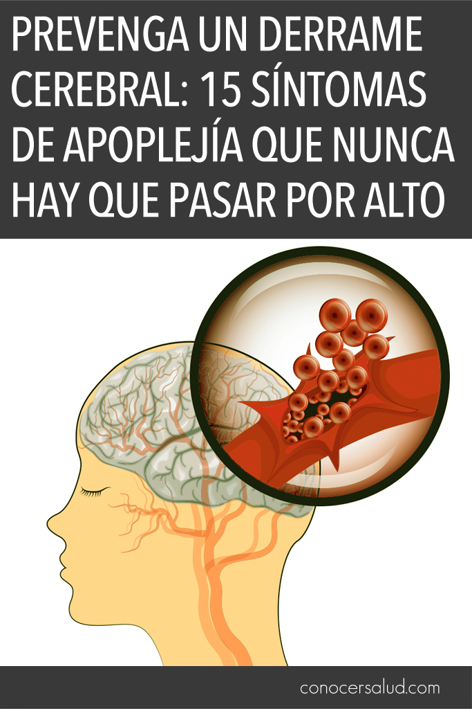 Prevenga un derrame cerebral: 15 síntomas de apoplejía que nunca hay que pasar por alto