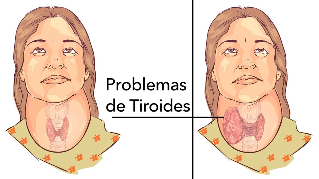 4 maneras fáciles de aliviar naturalmente los problemas de la tiroides