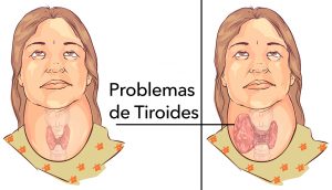 4 maneras fáciles de aliviar naturalmente los problemas de la tiroides