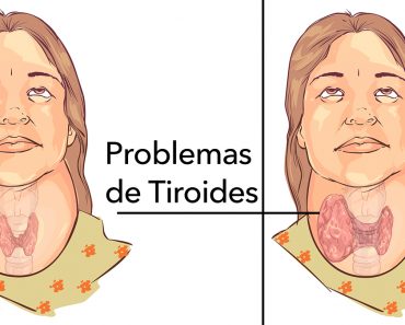 4 maneras fáciles de aliviar naturalmente los problemas de la tiroides