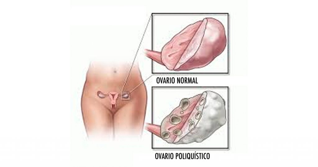 Cómo desayunar, comer y cenar para combatir el síndrome de ovario poliquístico