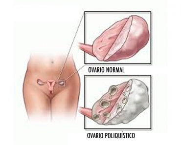 Cómo desayunar, comer y cenar para combatir el síndrome de ovario poliquístico