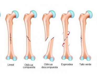 9 Alimentos que pueden ayudar a sanar huesos rotos más rápidamente