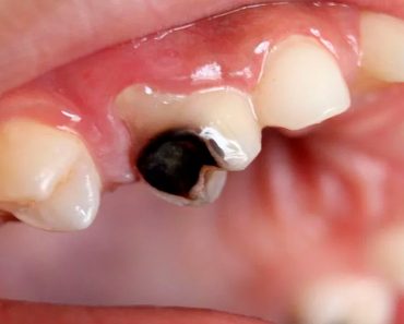 Pasos sencillos para aliviar naturalmente y remineralizar los dientes cariados