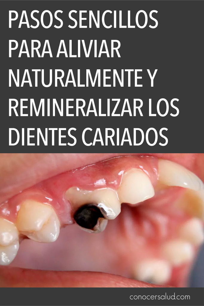 Pasos sencillos para aliviar naturalmente y remineralizar los dientes cariados