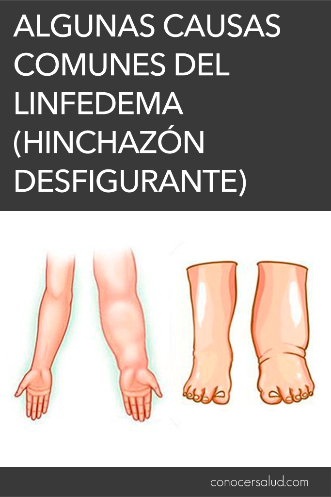 Algunas causas comunes del linfedema (hinchazón desfigurante)