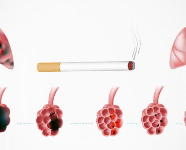 Cómo limpiar sus pulmones después de dejar de fumar