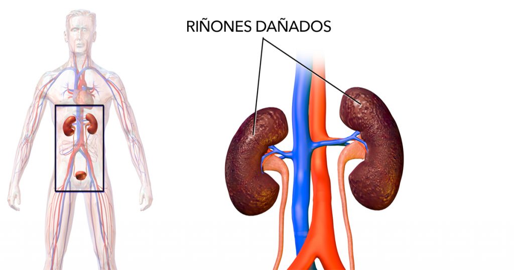 22 cosas que debes evitar para prevenir el daño renal