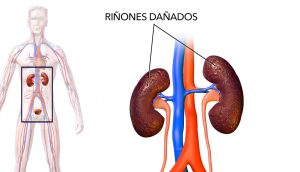 22 cosas que debes evitar para prevenir el daño renal