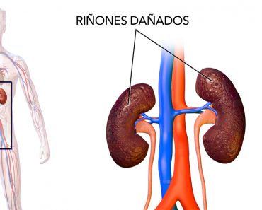 22 cosas que debes evitar para prevenir el daño renal