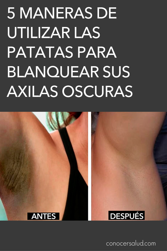 5 maneras de utilizar las patatas para blanquear sus axilas oscuras