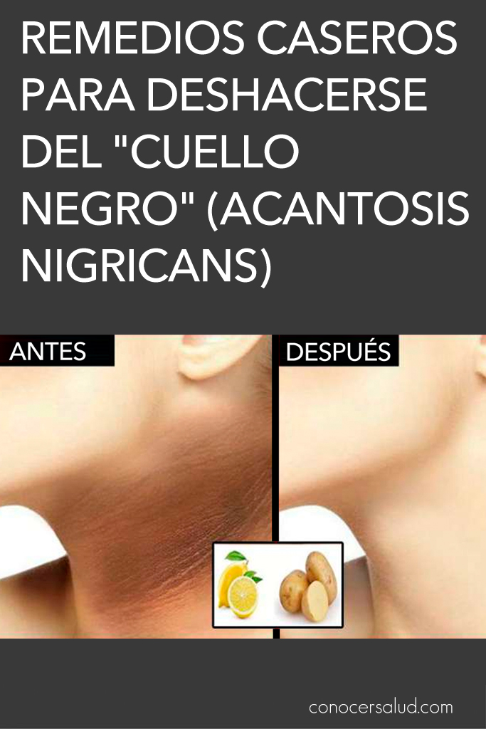 Remedios caseros para deshacerse del "cuello negro" (acantosis nigricans)