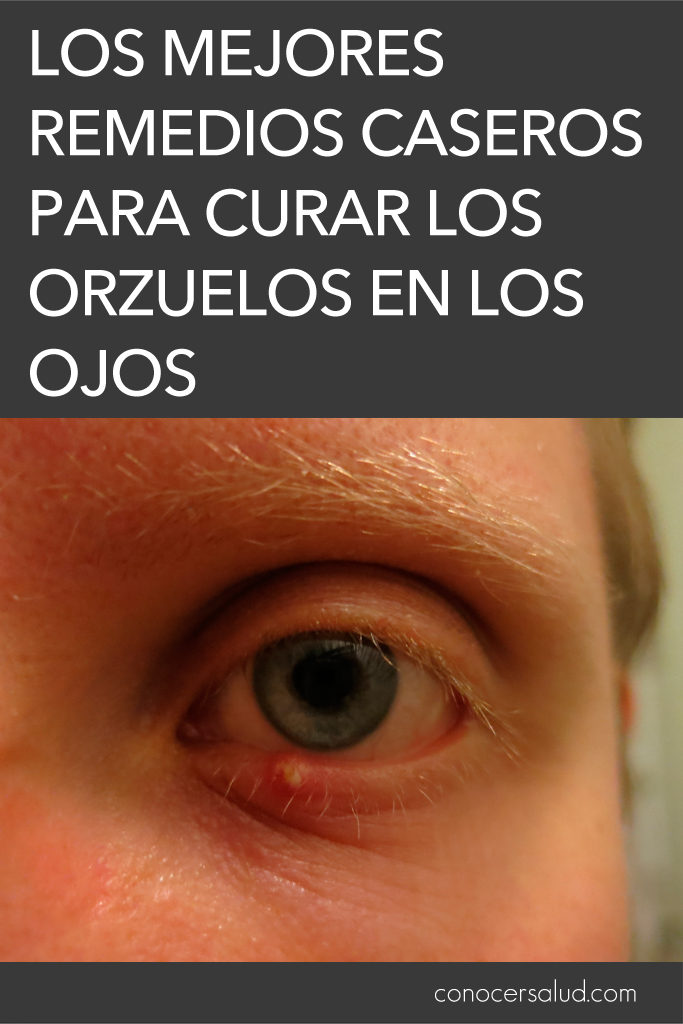 Los mejores remedios caseros para curar los orzuelos en los ojos