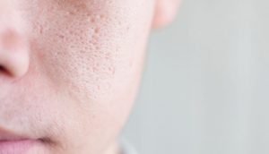 10 Remedios caseros para reducir los poros abiertos en su piel