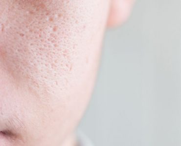 10 Remedios caseros para reducir los poros abiertos en su piel