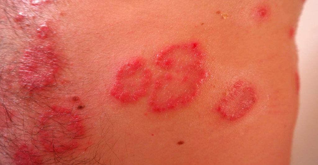 8 Remedios probados y naturales para tratar la psoriasis