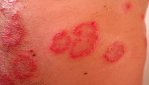 8 Remedios probados y naturales para tratar la psoriasis