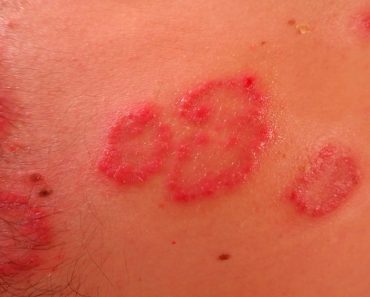 8 Remedios probados y naturales para tratar la psoriasis