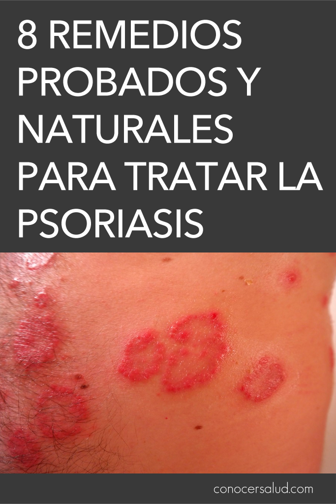 8 Remedios probados y naturales para tratar la psoriasis