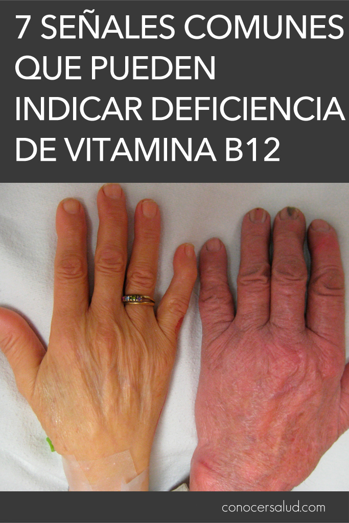 7 señales comunes que pueden indicar deficiencia de vitamina B12