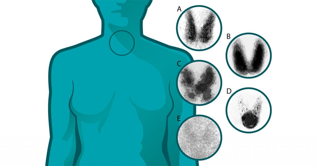 Millones de mujeres ignoran estos síntomas del trastorno de la tiroides. ¿Conoces las señales?