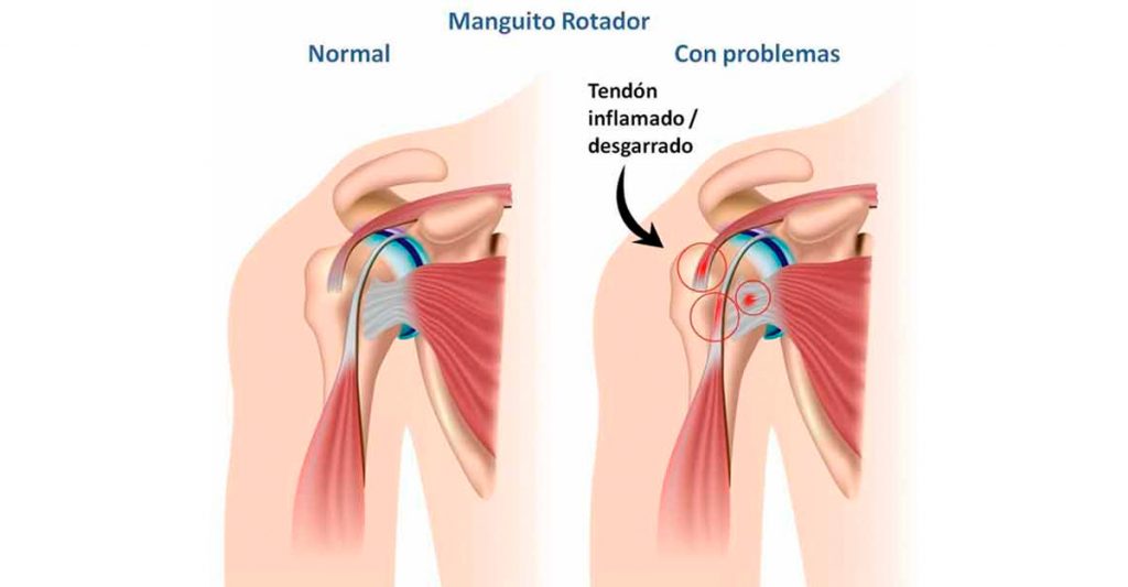 7 tratamientos naturales para el dolor del manguito rotador del hombro