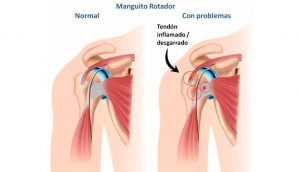 7 tratamientos naturales para el dolor del manguito rotador del hombro