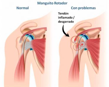7 tratamientos naturales para el dolor del manguito rotador del hombro