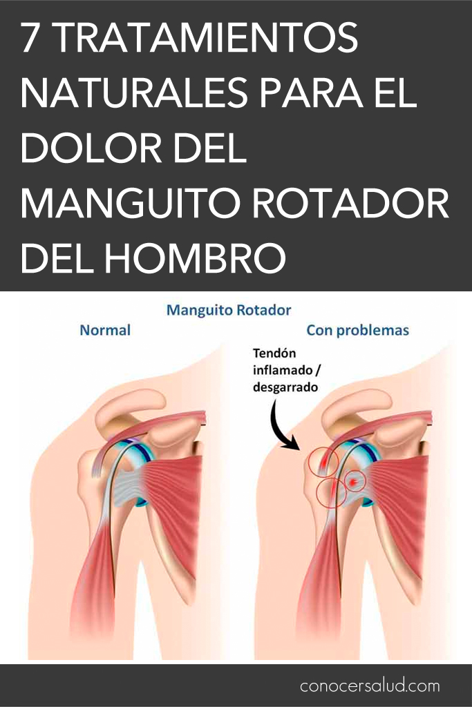 7 tratamientos naturales para el dolor del manguito rotador del hombro