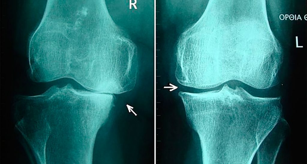 5 Hábitos alimenticios saludables para aliviar la osteoartritis de rodilla