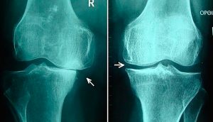 5 Hábitos alimenticios saludables para aliviar la osteoartritis de rodilla