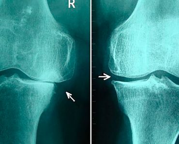 5 Hábitos alimenticios saludables para aliviar la osteoartritis de rodilla