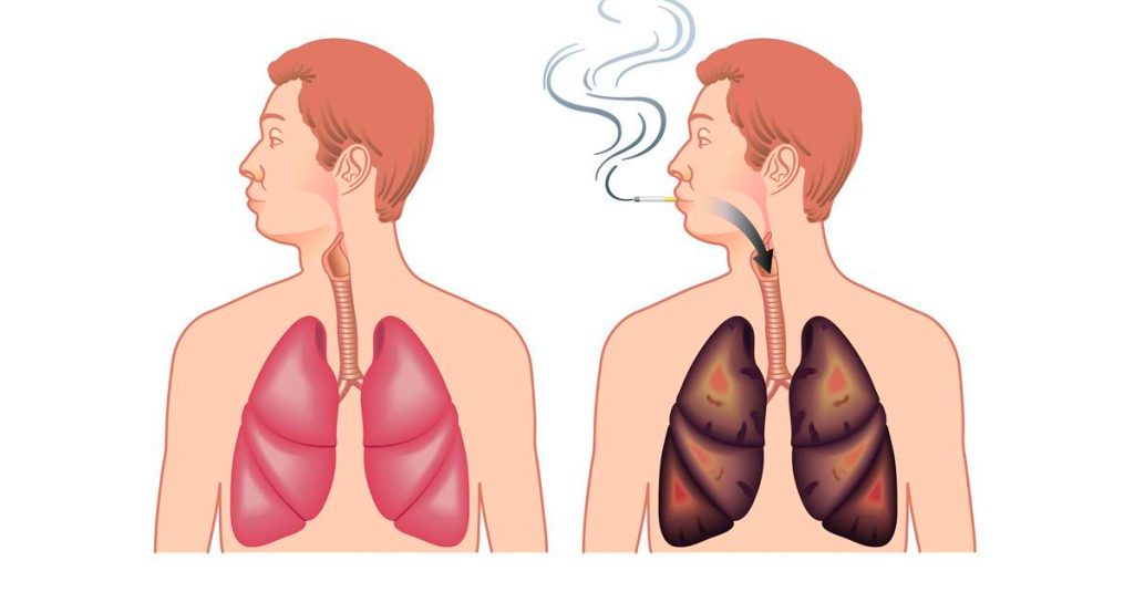 Cómo eliminar la nicotina de su cuerpo naturalmente