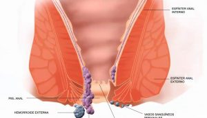 8 Causas de hemorroides (almorranas) que debe conocer