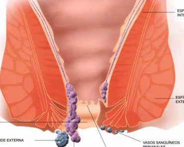 8 Causas de hemorroides (almorranas) que debe conocer