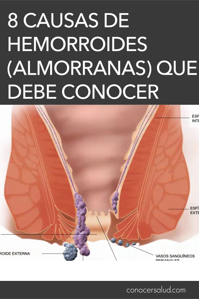 8 Causas de hemorroides (almorranas) que debe conocer