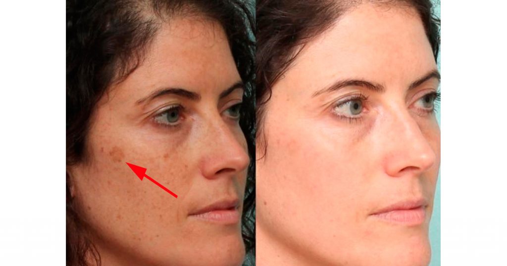 5 alimentos que pueden ayudar a eliminar las manchas oscuras de su cara