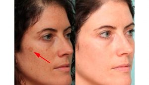 5 alimentos que pueden ayudar a eliminar las manchas oscuras de su cara