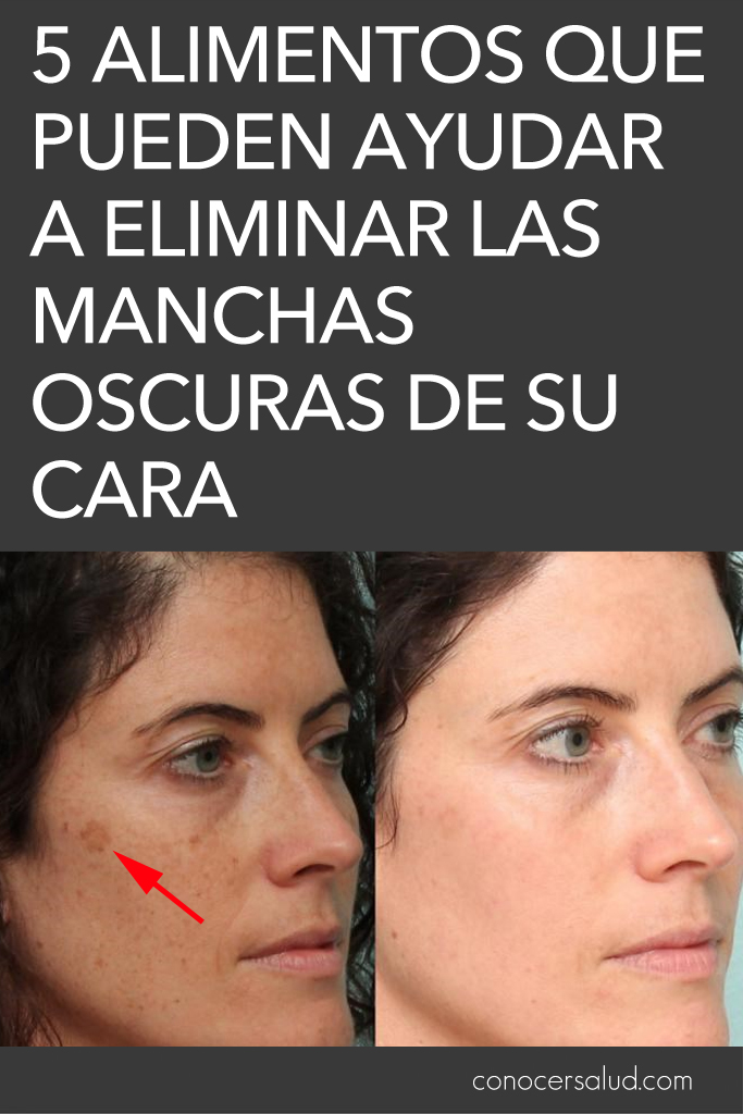 5 alimentos que pueden ayudar a eliminar las manchas oscuras de su cara